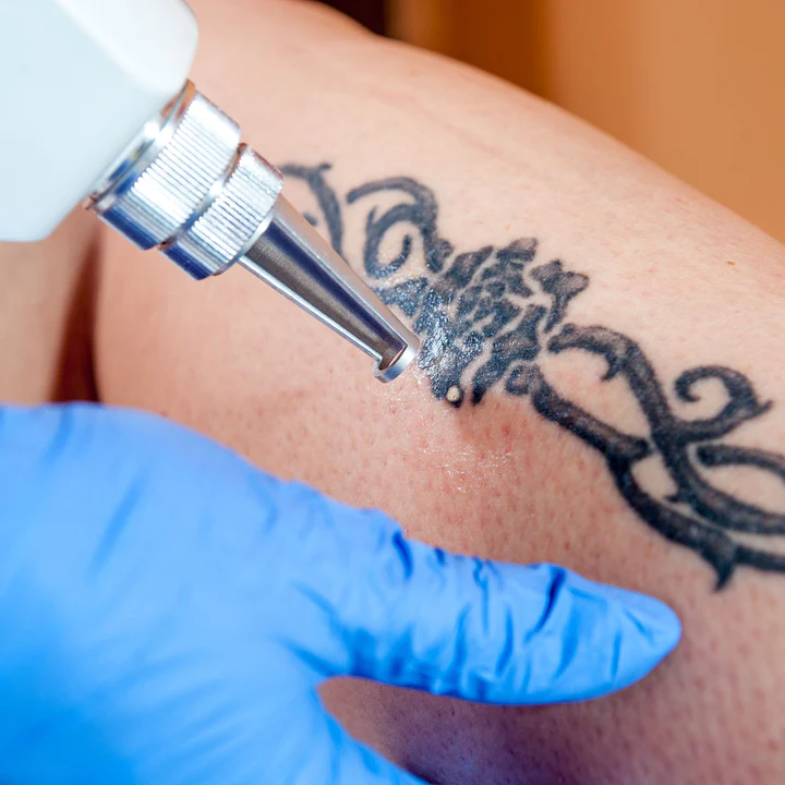 Tattoo Removal